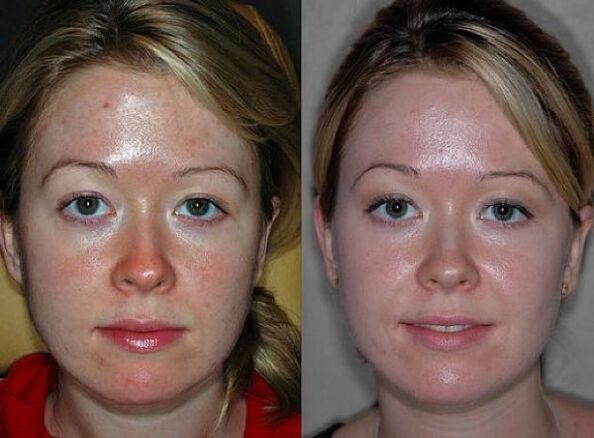 fotografii înainte și după procedura de întinerire a plasmei