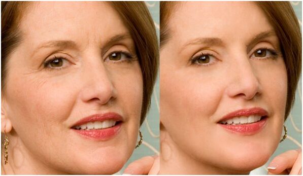 înainte și după întinerirea pielii feței plasmatice