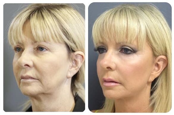 înainte și după întinerirea pielii cu strângere foto 2