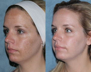 Fotografii înainte și după fracționată de întinerire a feței