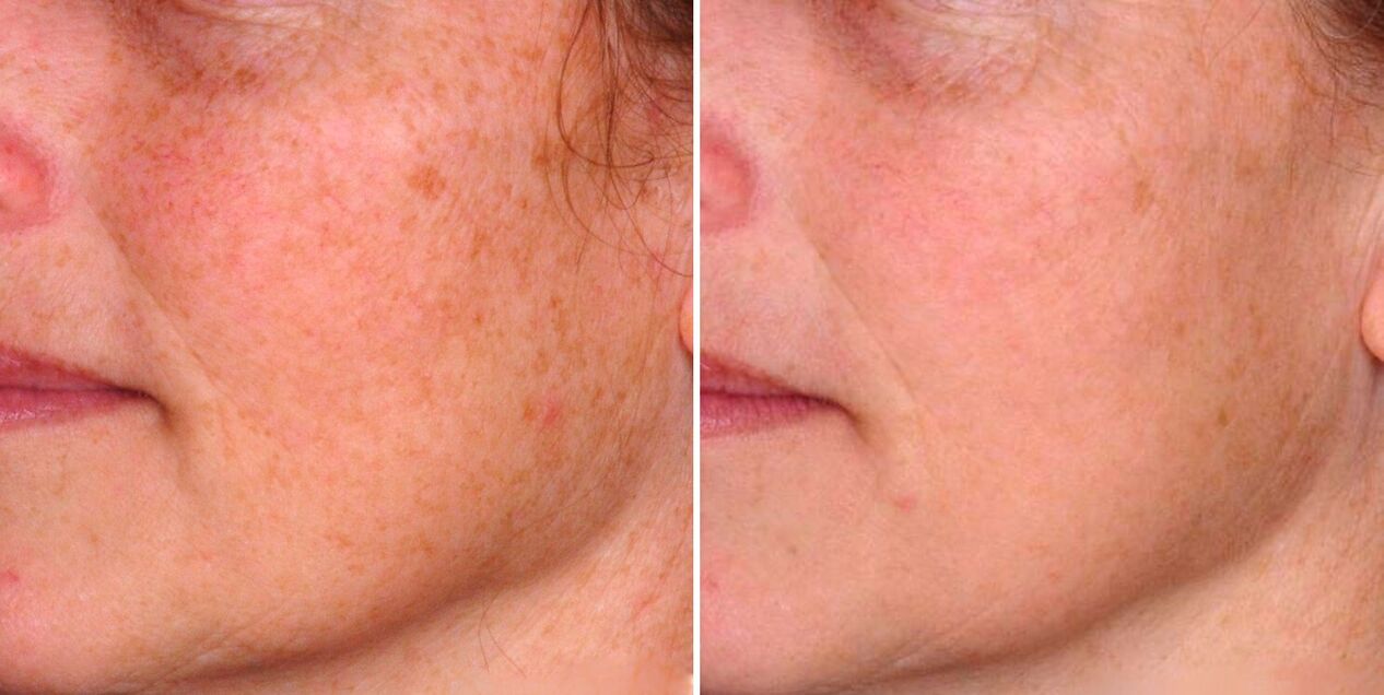 Rezultatul fototermolizei fracționate este reducerea petelor de vârstă de pe pielea feței. 