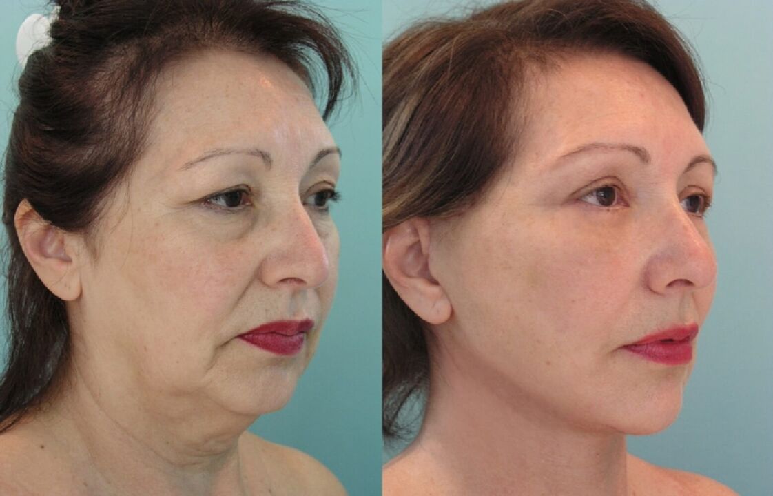 Înainte și după lifting facial