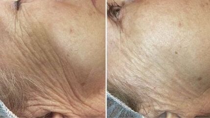 înainte și după întinerirea pielii cu laser