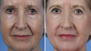 întinerire facială fracționată înainte și după fotografii